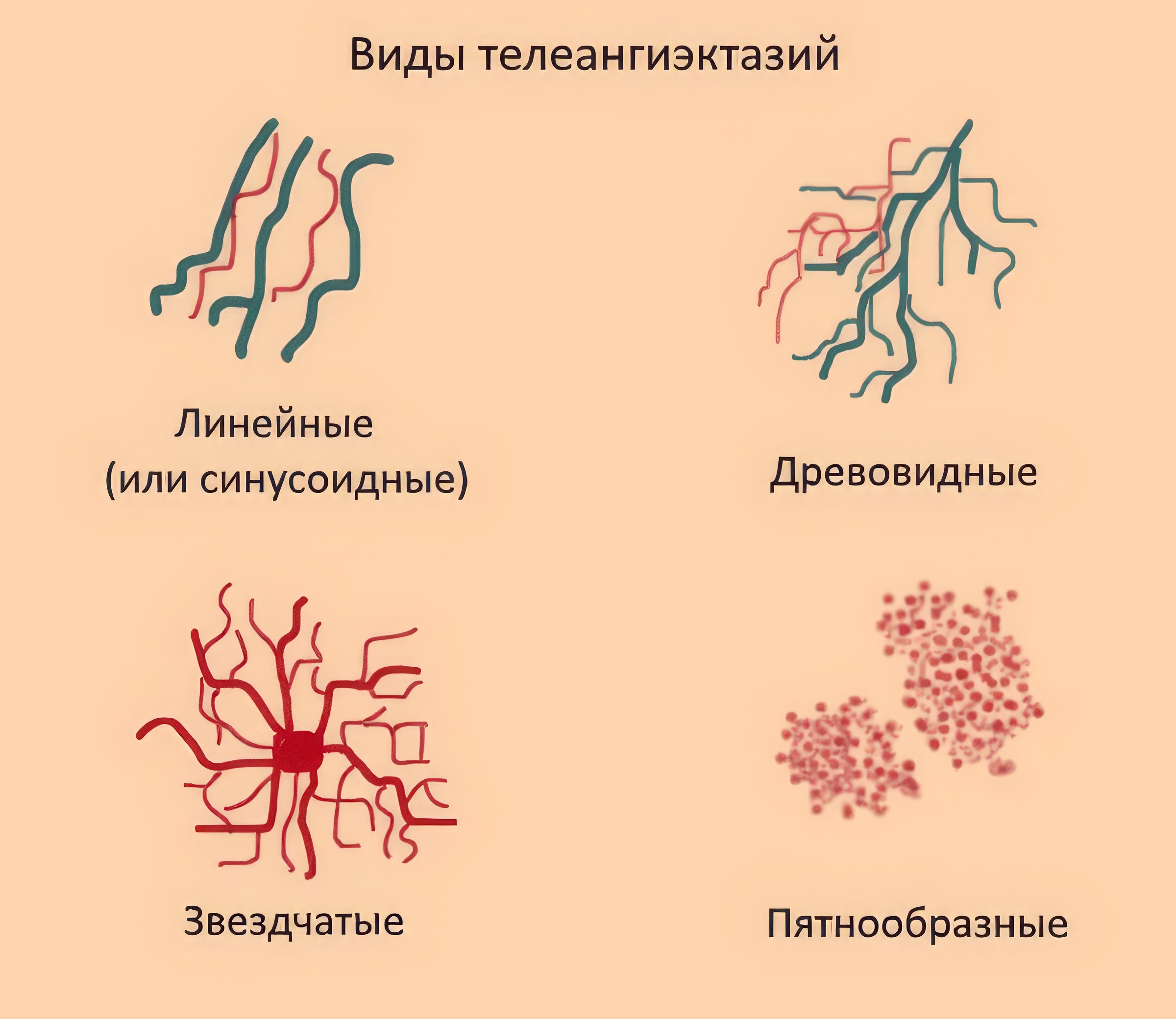 удпление сосудов лазером